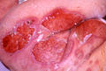 BULLOUS DISEASES - Pemphigus vulgaris