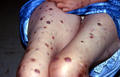 BACTERIAL INFECTIONS - Hansen disease