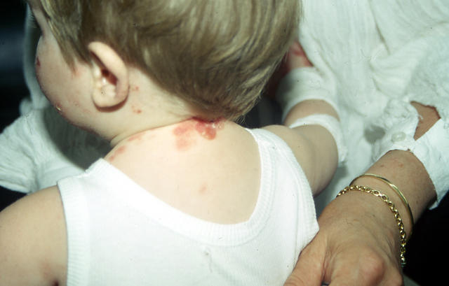 CONNECTIVE TISSUE DISORDERS - Epidermolysis bullosa aquisita