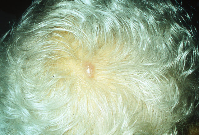DRUG ERUPTIONS - Drug eruption DRUG ERUPTIONS - Drug eruption