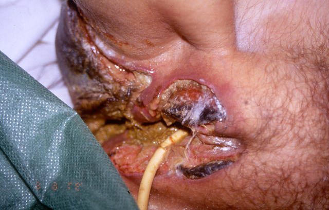 SKIN LESIONS IN HIV-AIDS PATIENTS - Perianal ulcers due to HSV and CMV infections