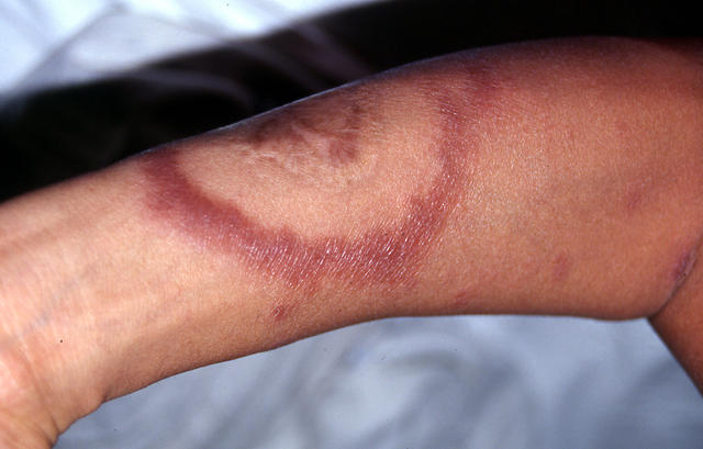 BACTERIAL INFECTIONS - Hansen disease BACTERIAL INFECTIONS - Hansen disease
