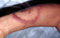 BACTERIAL INFECTIONS - Hansen disease