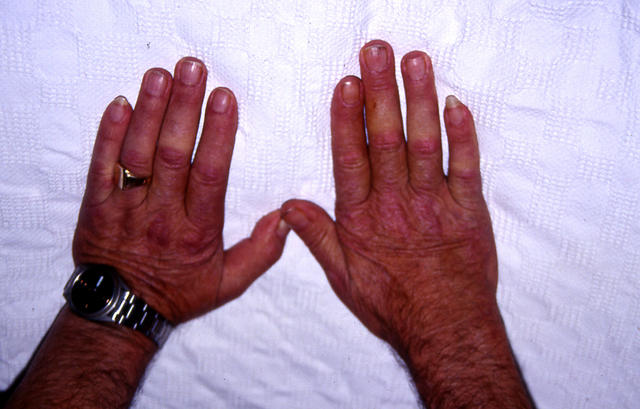 CONNECTIVE TISSUE DISORDERS - Dermatomyositis
