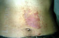 DERMATITIS - EKZEMA - Allergic Contact Dermatitis