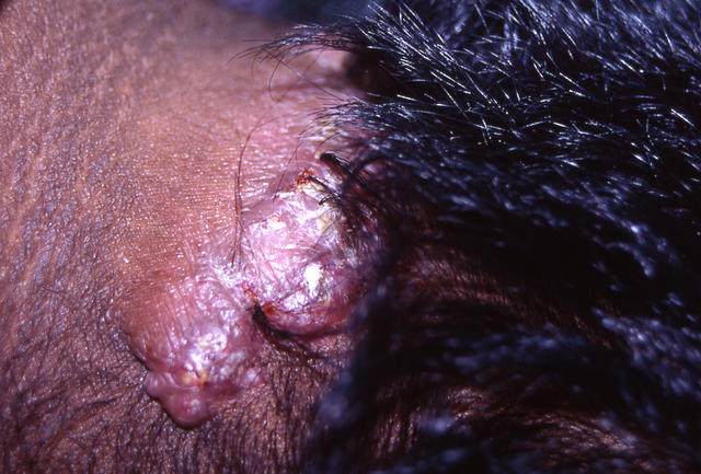SOFT TISSUE TUMORS - Cheloids SOFT TISSUE TUMORS - Cheloids