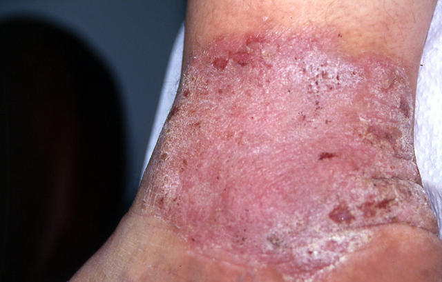 DERMATITIS - EKZEMA - Eczema DERMATITIS - EKZEMA - Eczema