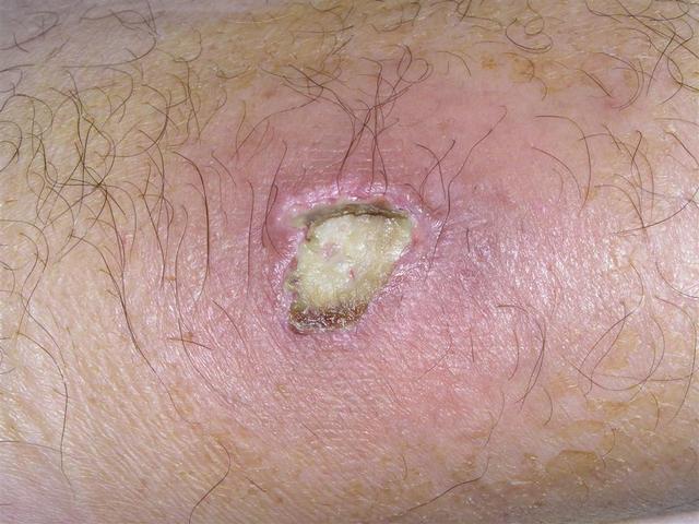 DISEASE OF THE BLOOD AND THE VESSELS – PURPURAS - Pyoderma Gangrenosum