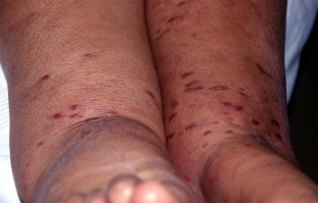 SOFT TISSUE TUMORS - Kaposi sarcoma