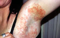 SUPERFICIAL FUNGAL INFECTIONS - Tinea Incognita