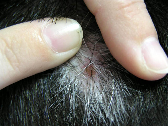 BENIGN SKIN LESIONS, NEVI, CYSTS - Naevus of Sutton