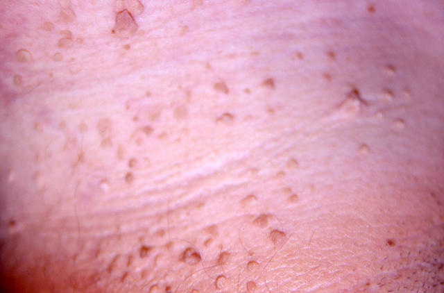KERATINISATION DISORDERS - Pseudoacanthosis nigricans KERATINISATION DISORDERS - Pseudoacanthosis nigricans