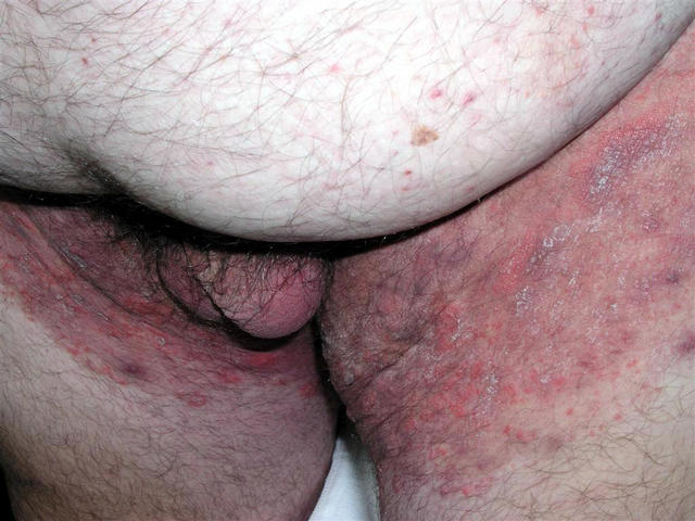 SUPERFICIAL FUNGAL INFECTIONS - Tinea incognito