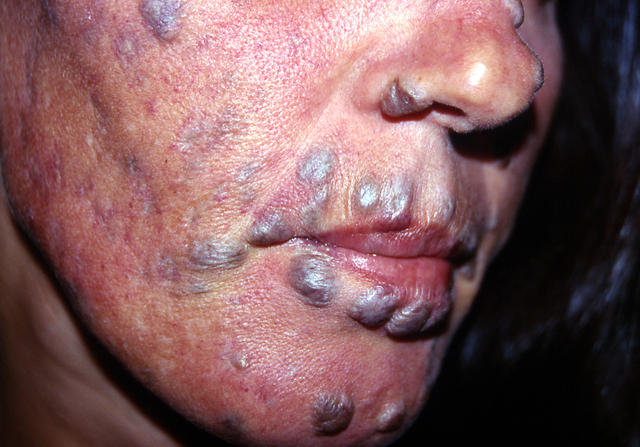 BACTERIAL INFECTIONS - Hansen disease BACTERIAL INFECTIONS - Hansen disease