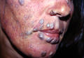 BACTERIAL INFECTIONS - Hansen disease