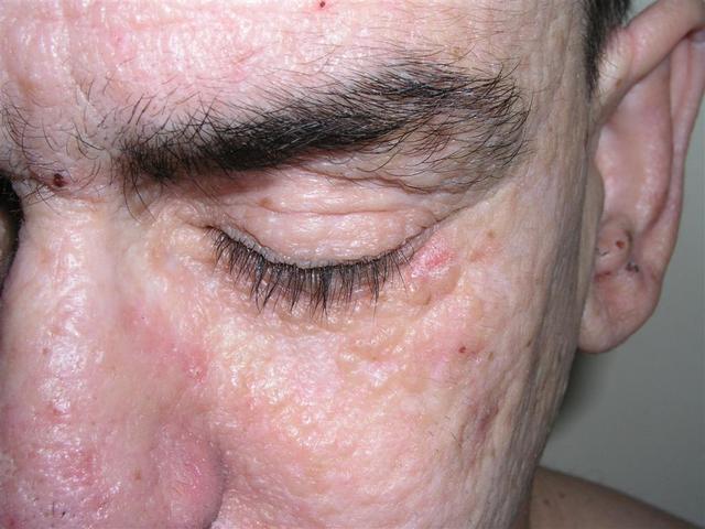 METABOLIC DISEASE, NUTRITION - Lipoid proteinosis (Urbach - Wiethe syndrome) METABOLIC DISEASE, NUTRITION - Lipoid proteinosis (Urbach - Wiethe syndrome)
