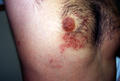 VIRAL INFECTIONS - Herpes Zoster