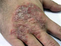 SUPERFICIAL FUNGAL INFECTIONS - Tinea incognita