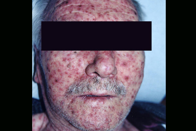 DRUG ERUPTIONS - Drug eruption DRUG ERUPTIONS - Drug eruption