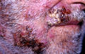 SUPERFICIAL FUNGAL INFECTIONS - Sycosis barbae due to dermatophyte infection