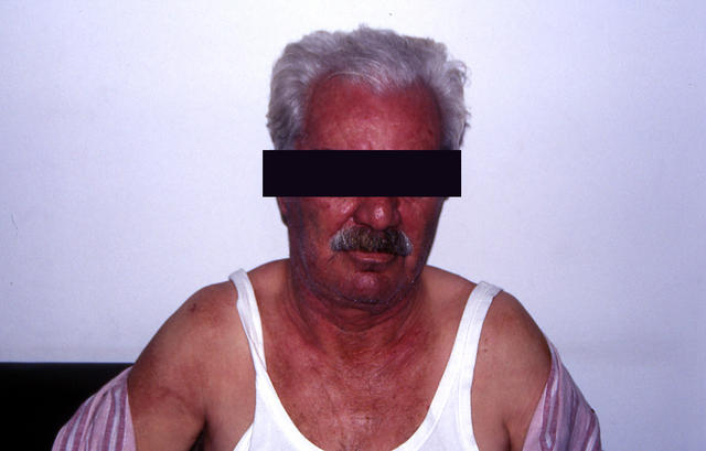 CONNECTIVE TISSUE DISORDERS - Dermatomyositis