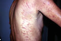 DERMATITIS - EKZEMA - Neurodermatitis