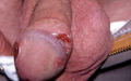 SYPHILIS AND OTHER SEXUAL TRANSMITTED DISEASES - Ulcer, primary syphilis