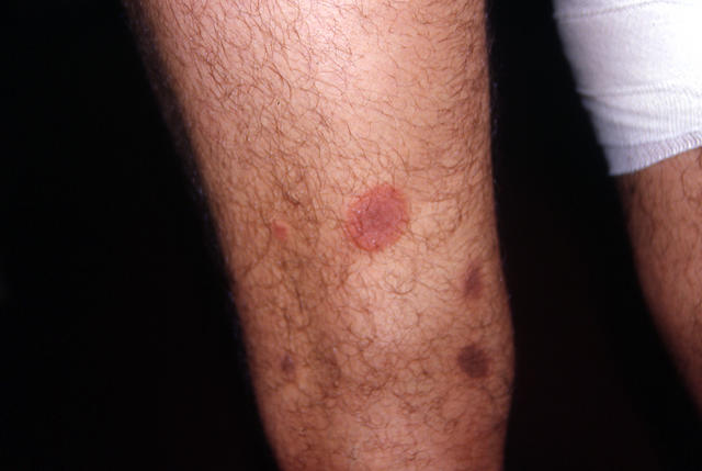DRUG ERUPTIONS - Fixed drug eruption DRUG ERUPTIONS - Fixed drug eruption