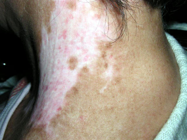 GENODERMATOSES - Epidemolysis bullosa, congenital