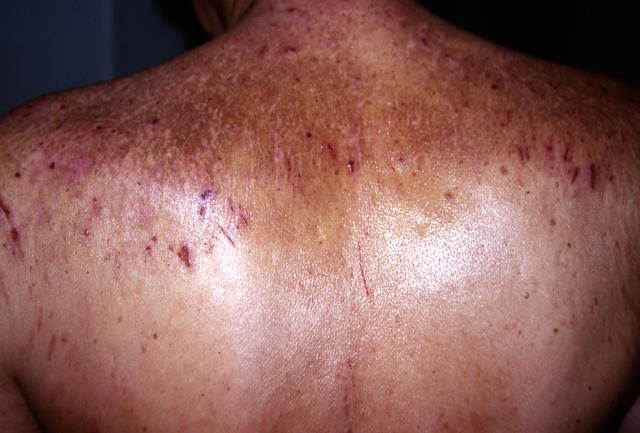 DERMATITIS - EKZEMA - Neurodermatitis