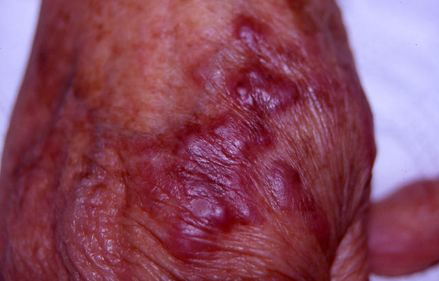 SOFT TISSUE TUMORS - Kaposi sarcoma