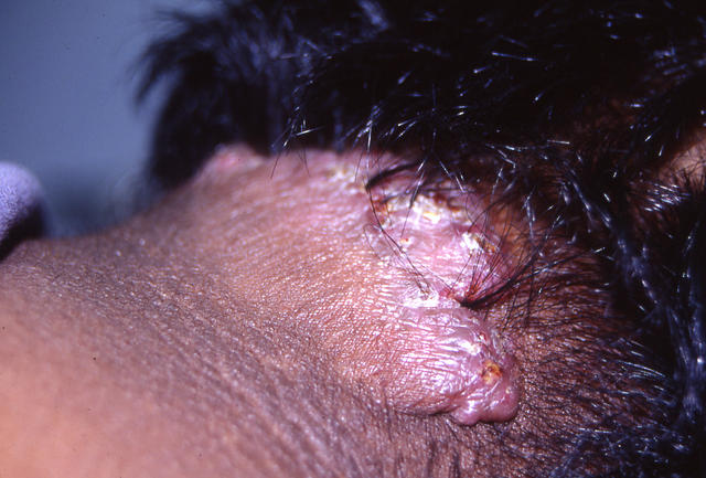 SOFT TISSUE TUMORS - Cheloids SOFT TISSUE TUMORS - Cheloids