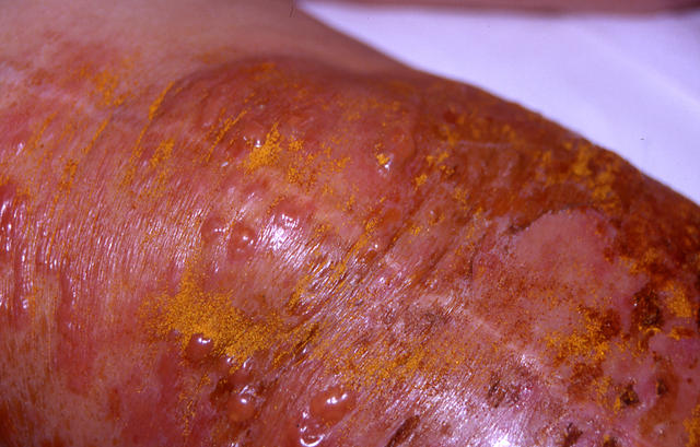 BACTERIAL INFECTIONS - Erysipelas