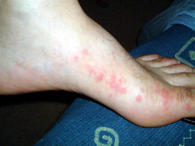 URTICARIA - Urticaria URTICARIA - Urticaria