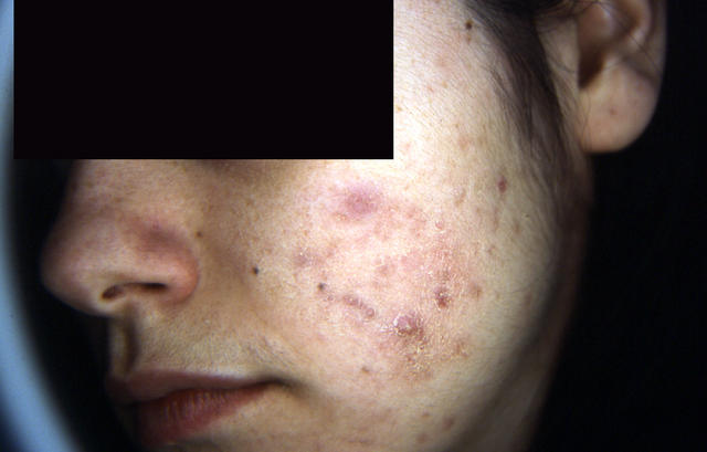 DISEASES OF THE SEBACEOUS GLANDS - Acne, Cystic DISEASES OF THE SEBACEOUS GLANDS - Acne, Cystic