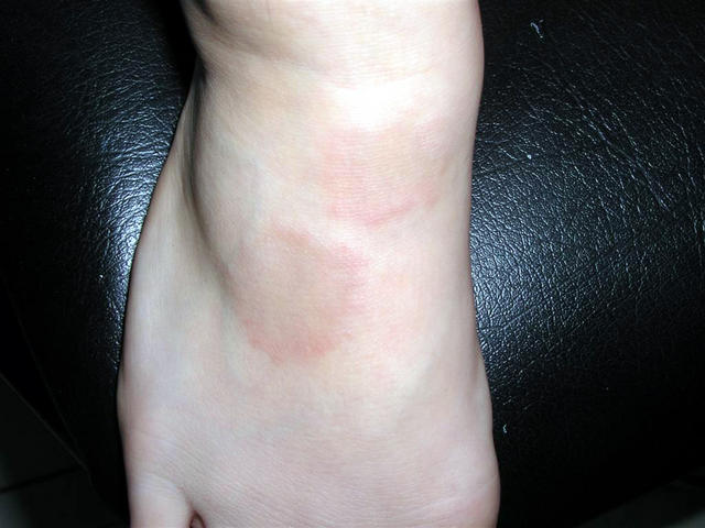 NECROBIOTIC DISORDERS - Granuloma Annulare NECROBIOTIC DISORDERS - Granuloma Annulare