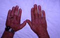 CONNECTIVE TISSUE DISORDERS - Dermatomyositis
