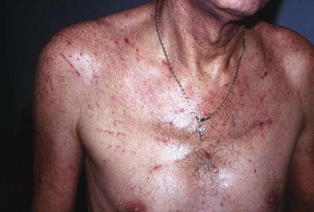 DERMATITIS - EKZEMA - Neurodermatitis