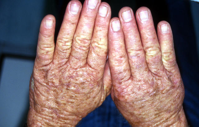 AGEING, PHOTOAGEING - Senile Lentiles AGEING, PHOTOAGEING - Senile Lentiles