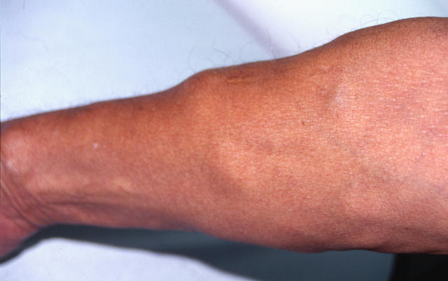 VARIOUS or of UNKNOWN ETIOLOGY DISEASES - Multiple lipomas syndrome VARIOUS or of UNKNOWN ETIOLOGY DISEASES - Multiple lipomas syndrome