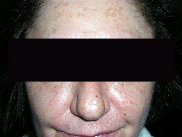 GENODERMATOSES - Epidemolysis bullosa, congenital GENODERMATOSES - Epidemolysis bullosa, congenital