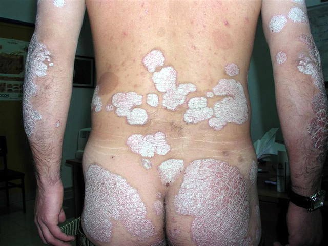 PSORIASIS - Plaque psoriasis