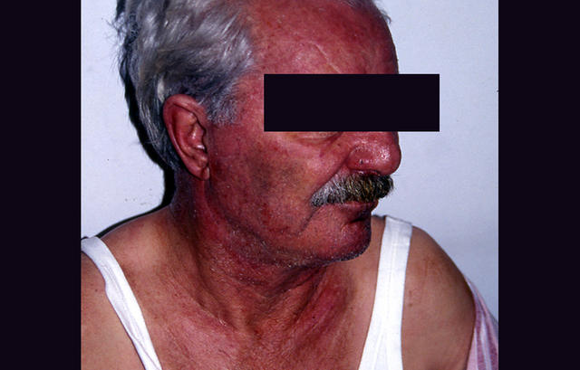 CONNECTIVE TISSUE DISORDERS - Dermatomyositis