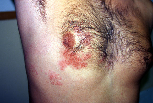 VIRAL INFECTIONS - Herpes Zoster