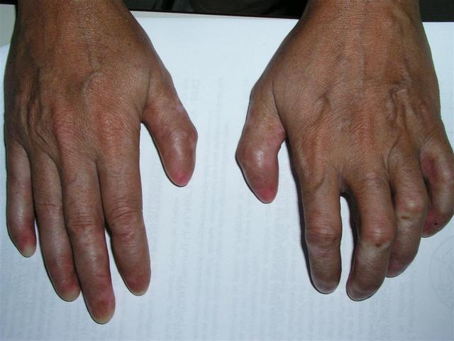 GENODERMATOSES - Epidemolysis bullosa, congenital GENODERMATOSES - Epidemolysis bullosa, congenital