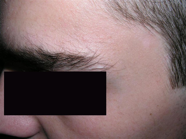 BENIGN SKIN LESIONS, NEVI, CYSTS - Naevus of Sutton BENIGN SKIN LESIONS, NEVI, CYSTS - Naevus of Sutton