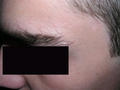 BENIGN SKIN LESIONS, NEVI, CYSTS - Naevus of Sutton