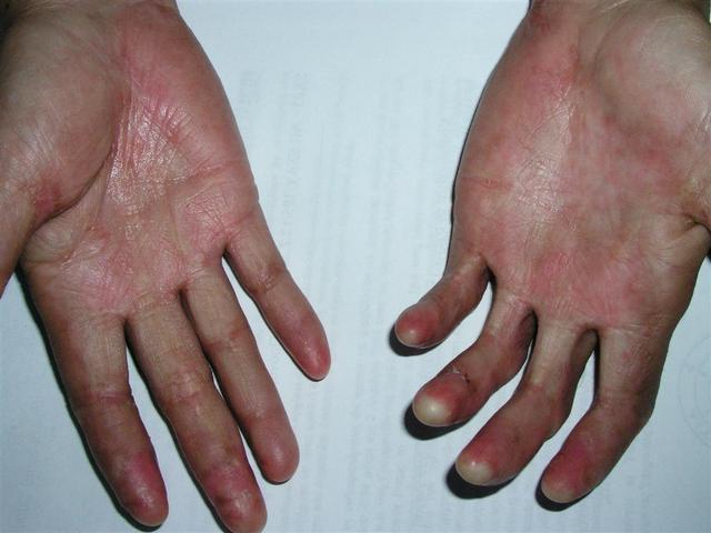 GENODERMATOSES - Epidemolysis bullosa, congenital