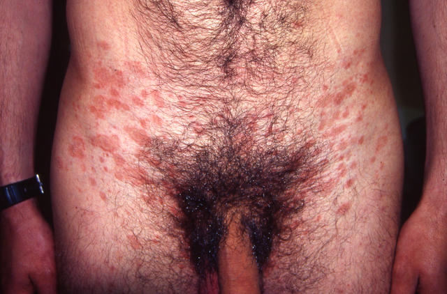 VARIOUS or of UNKNOWN ETIOLOGY DISEASES - Pityriasis rosea