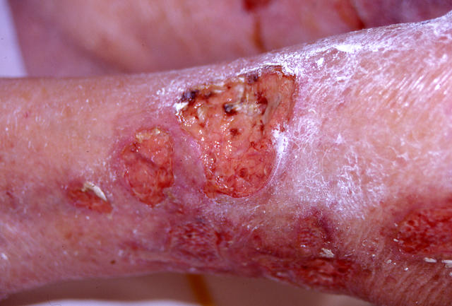BULLOUS DISEASES - Pemphigus vulgaris BULLOUS DISEASES - Pemphigus vulgaris